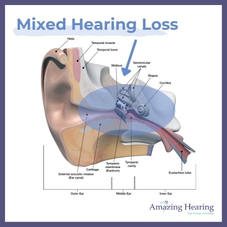 Mixed Hearing Loss Singapore