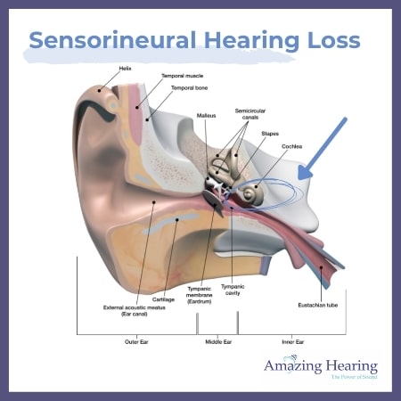 Sensorineural Hearing Loss in singapore - causes and prevention