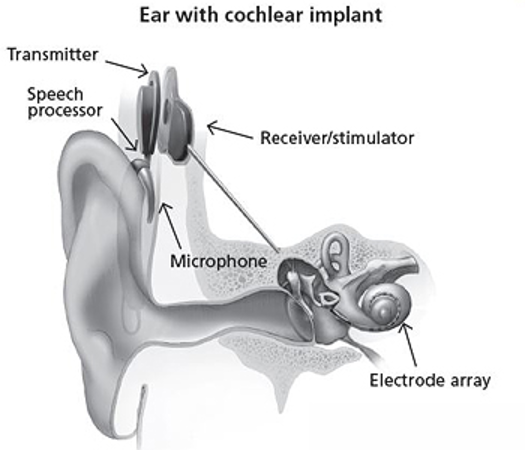 cochlea implant singapore cochlea mapping