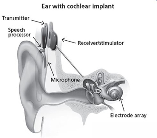cochlea implant singapore cochlea mapping